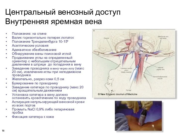 Центральный венозный доступ Внутренняя яремная вена Положение: на спине Валик