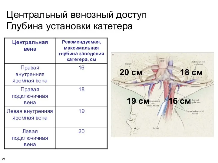 Центральный венозный доступ Глубина установки катетера 20 см 18 см 19 см 16 см