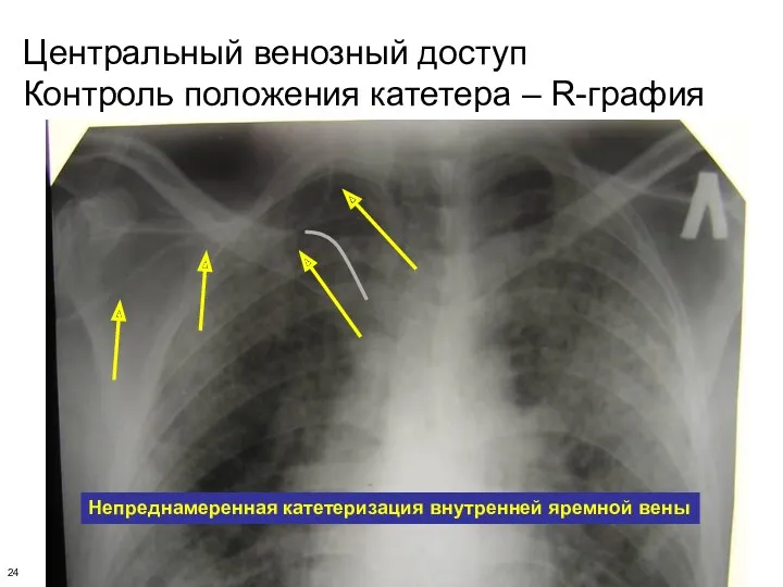 Центральный венозный доступ Контроль положения катетера – R-графия Непреднамеренная катетеризация внутренней яремной вены