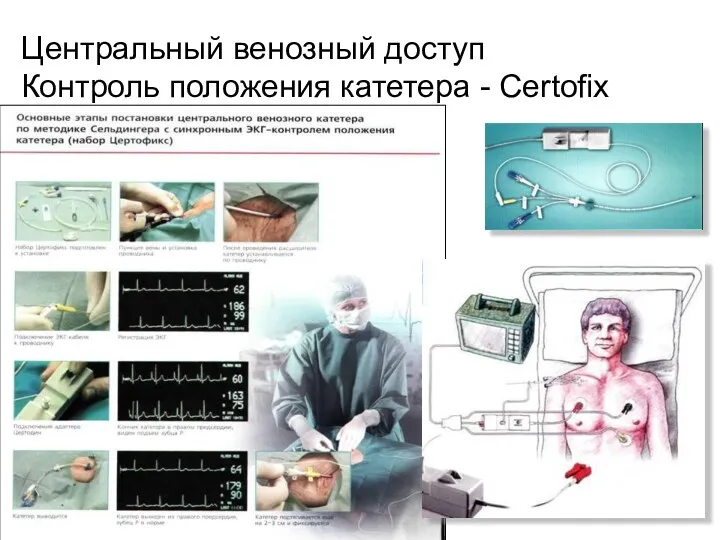 Центральный венозный доступ Контроль положения катетера - Certofix