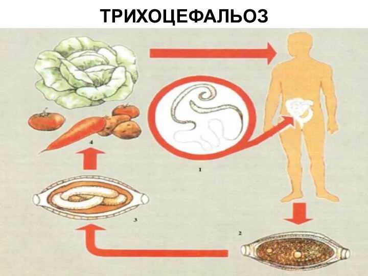 ТРИХОЦЕФАЛЬОЗ