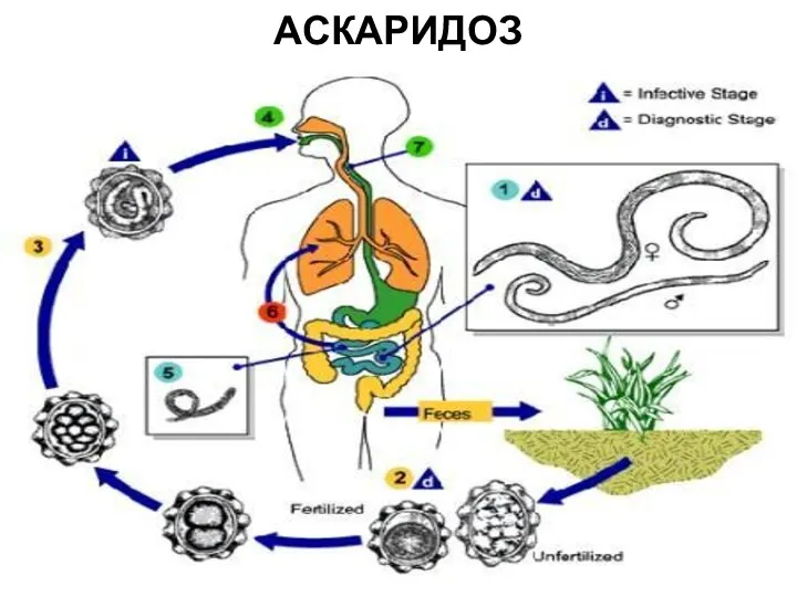 АСКАРИДОЗ