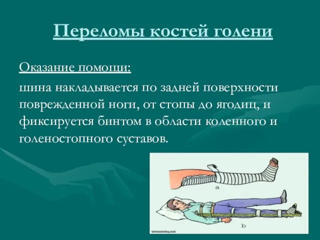 Переломы костей голени Оказание помощи: шина накладывается по задней поверхности