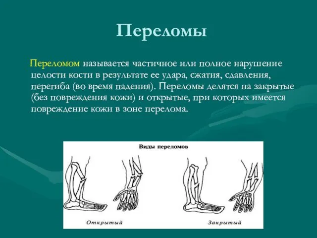 Переломы Переломом называется частичное или полное нарушение целости кости в