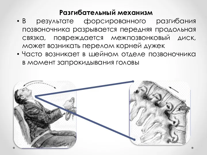 Разгибательный механизм В результате форсированного разгибания позвоночника разрывается передняя продольная