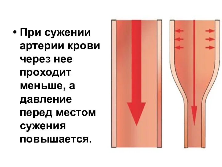 При сужении артерии крови через нее проходит меньше, а давление перед местом сужения повышается.