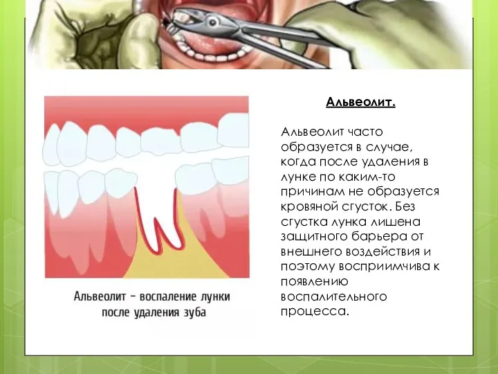 Альвеолит. Альвеолит часто образуется в случае, когда после удаления в