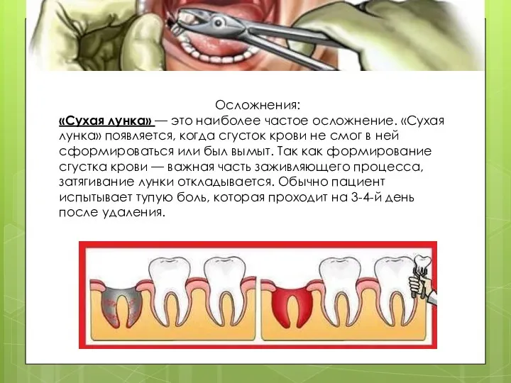 Осложнения: «Сухая лунка» — это наиболее частое осложнение. «Сухая лунка»