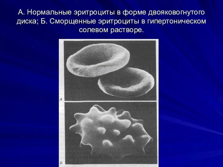 А. Нормальные эритроциты в форме двояковогнутого диска; Б. Сморщенные эритроциты в гипертоническом солевом растворе.