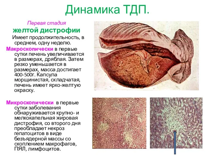 Динамика ТДП. Первая стадия желтой дистрофии Имеет продолжительность, в среднем,