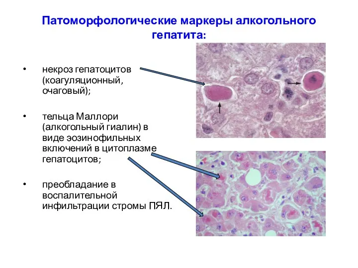 Патоморфологические маркеры алкогольного гепатита: некроз гепатоцитов (коагуляционный, очаговый); тельца Маллори