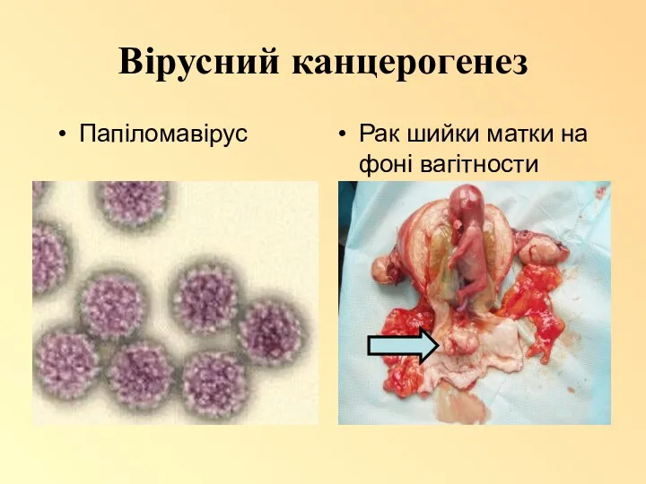 Вірусний канцерогенез Папіломавірус Рак шийки матки на фоні вагітности