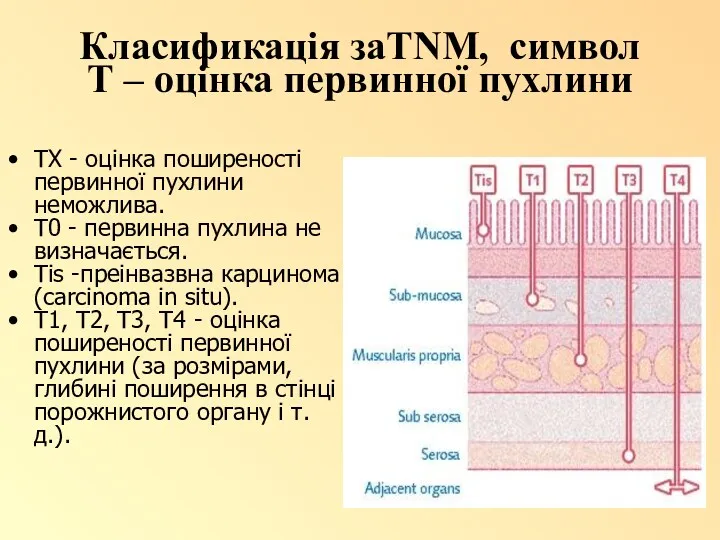 Класификація заTNM, символ Т – оцінка первинної пухлини ТХ - оцінка поширеності первинної