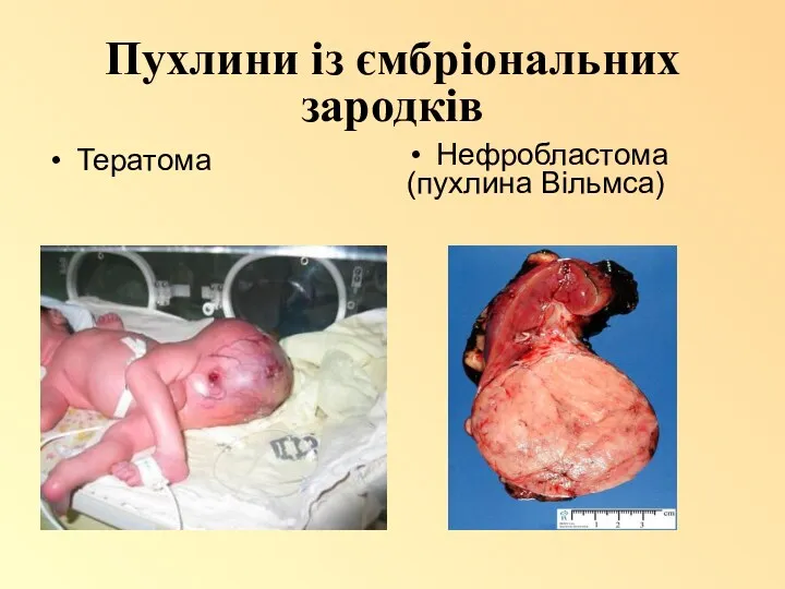Пухлини із ємбріональних зародків Тератома Нефробластома (пухлина Вільмса)