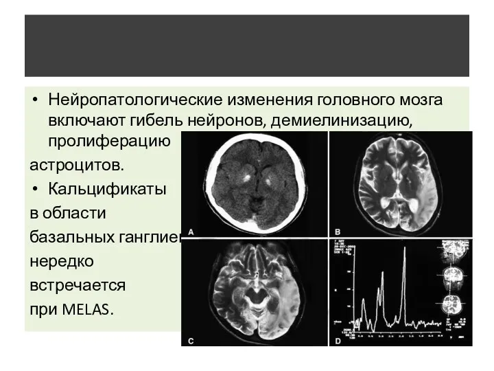 Нейропатологические изменения головного мозга включают гибель нейронов, демиелинизацию, пролиферацию астроцитов. Кальцификаты в области