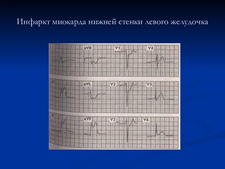 Инфаркт миокарда нижней стенки левого желудочка