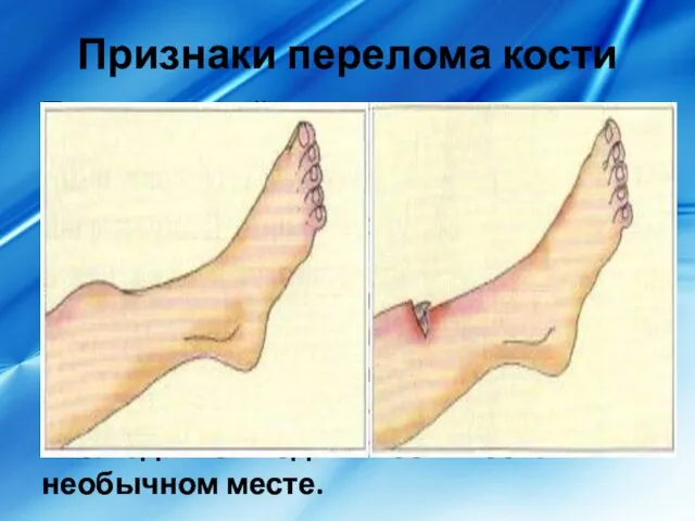 Признаки перелома кости Пострадавший испытывает сильную боль при малейшей попытке движения повреждённой рукой