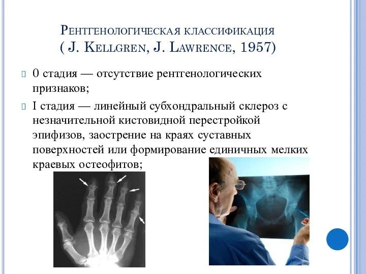 Рентгенологическая классификация ( J. Kellgren, J. Lawrence, 1957) 0 стадия