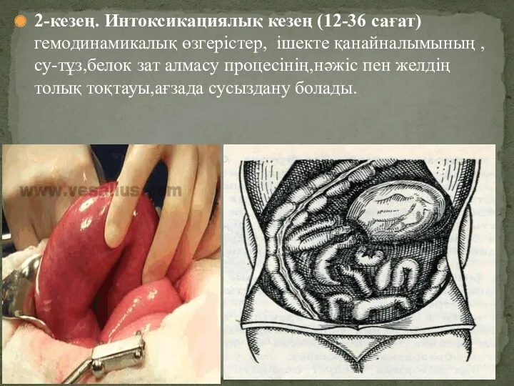 2-кезең. Интоксикациялық кезең (12-36 сағат) гемодинамикалық өзгерістер, ішекте қанайналымының ,су-тұз,белок