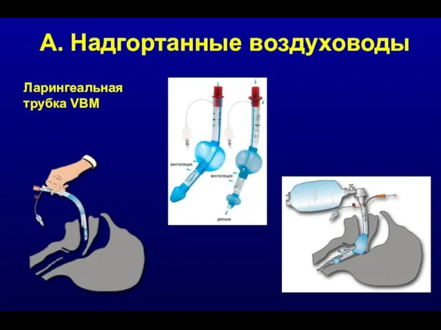 А. Надгортанные воздуховоды Ларингеальная трубка VBM