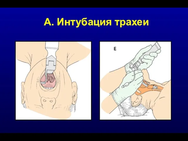 А. Интубация трахеи