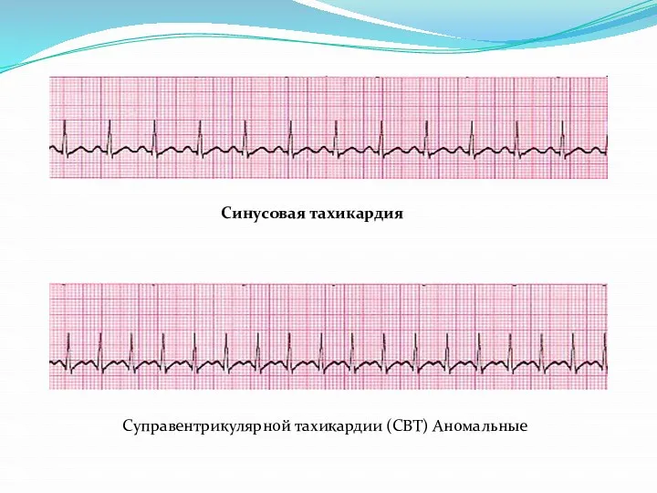 Синусовая тахикардия Суправентрикулярной тахикардии (СВТ) Аномальные