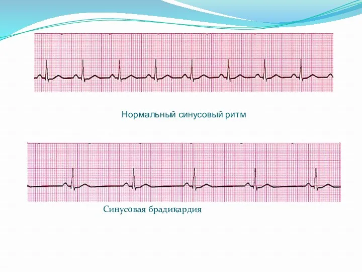 Нормальный синусовый ритм Синусовая брадикардия