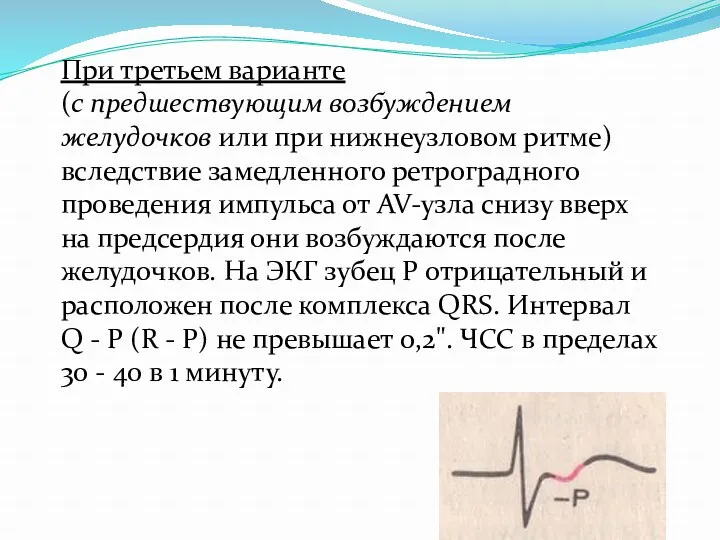 При третьем варианте (с предшествующим возбуждением желудочков или при нижнеузловом
