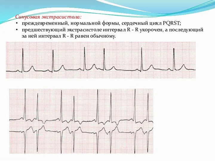 Синусовая экстрасистола: преждевременный, нормальной формы, сердечный цикл PQRST; предшествующий экстрасистоле