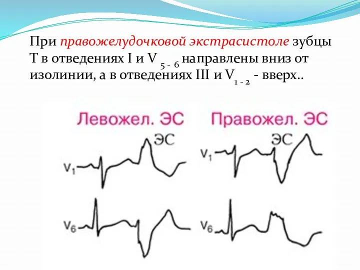 При правожелудочковой экстрасистоле зубцы Т в отведениях I и V