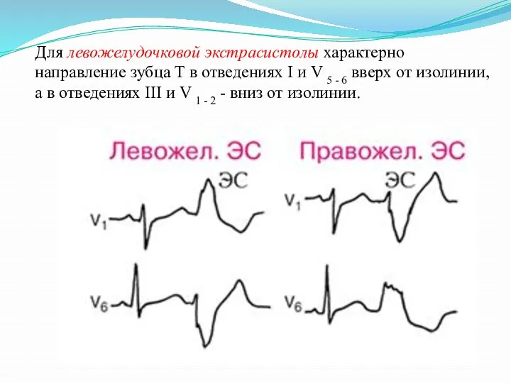 Для левожелудочковой экстрасистолы характерно направление зубца Т в отведениях I