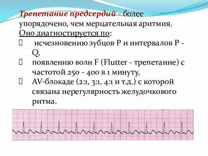 Трепетание предсердий - более упорядочено, чем мерцательная аритмия. Оно диагностируется