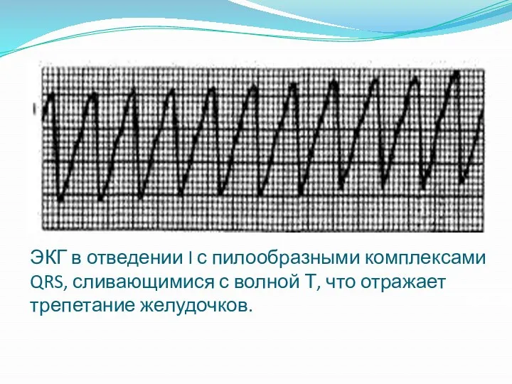 ЭКГ в отведении I с пилообразными комплексами QRS, сливающимися с волной Т, что отражает трепетание желудочков.