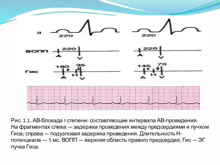 Рис. 1.1. АВ-блокада I степени: составляющие интервала АВ-проведения. На фрагментах