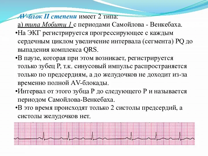 AV-блок II степени имеет 2 типа: а) типа Мобитц 1