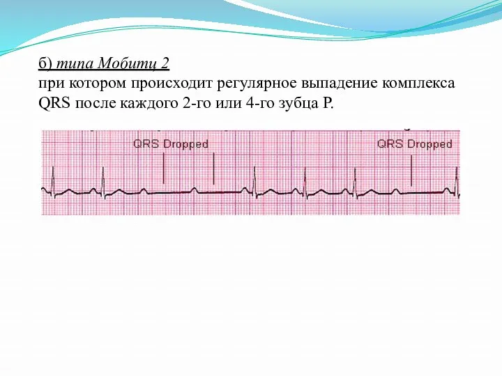 б) типа Мобитц 2 при котором происходит регулярное выпадение комплекса