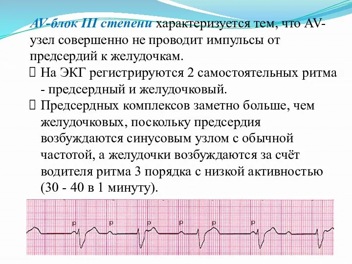 AV-блок III степени характеризуется тем, что AV-узел совершенно не проводит