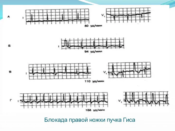 Блокада правой ножки пучка Гиса