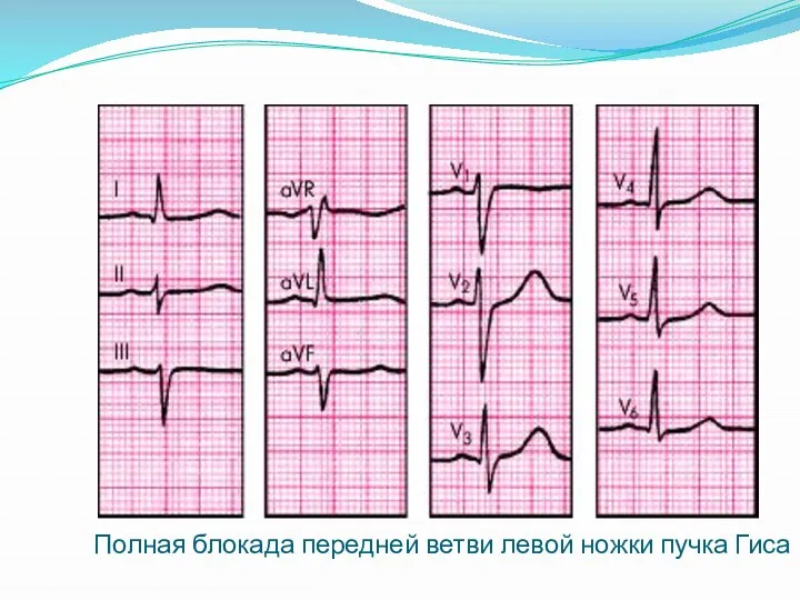 Полная блокада передней ветви левой ножки пучка Гиса