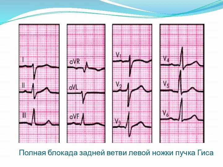 Полная блокада задней ветви левой ножки пучка Гиса