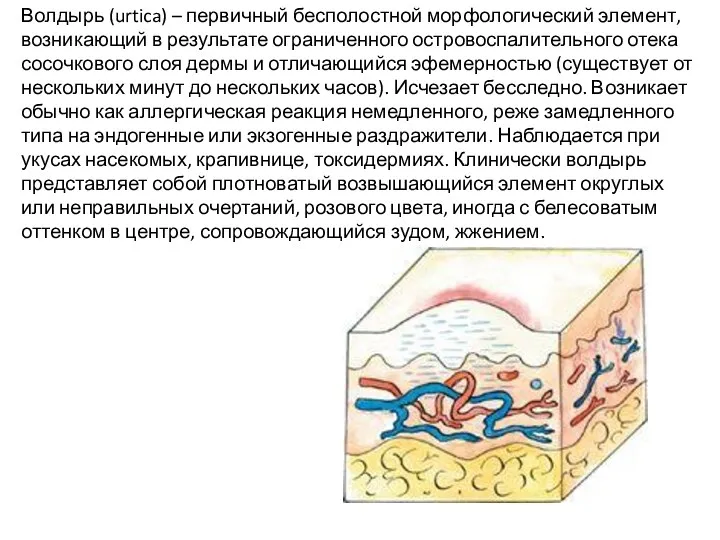 Волдырь (urtica) – первичный бесполостной морфологический элемент, возникающий в результате