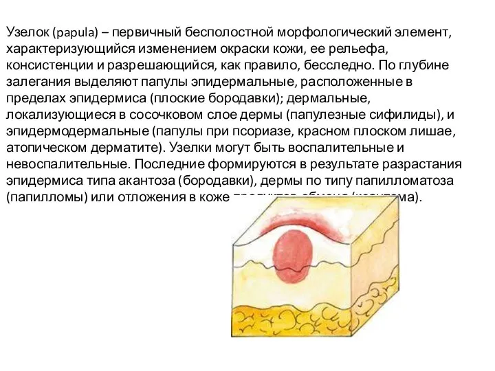 Узелок (papula) – первичный бесполостной морфологический элемент, характеризующийся изменением окраски