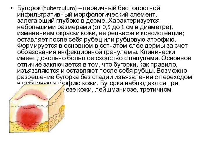 Бугорок (tuberculum) – первичный бесполостной инфильтративный морфологический элемент, залегающий глубоко