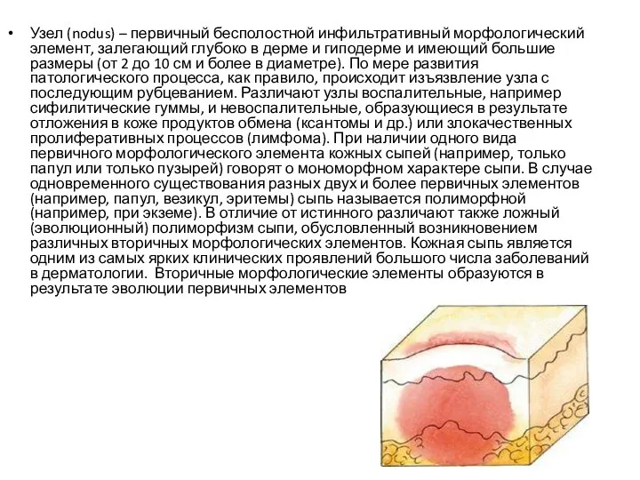 Узел (nodus) – первичный бесполостной инфильтративный морфологический элемент, залегающий глубоко