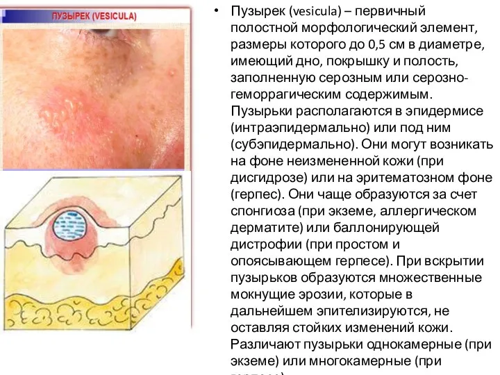 Пузырек (vesicula) – первичный полостной морфологический элемент, размеры которого до