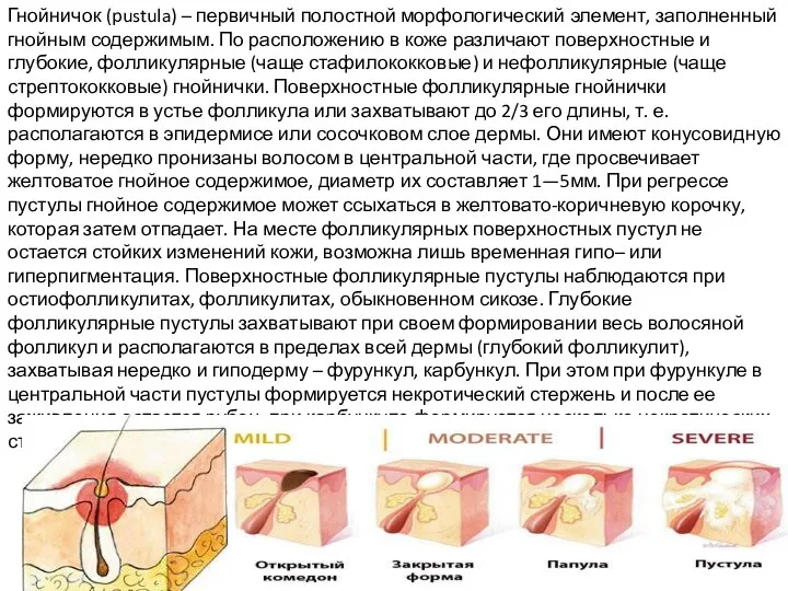 Гнойничок (pustula) – первичный полостной морфологический элемент, заполненный гнойным содержимым.