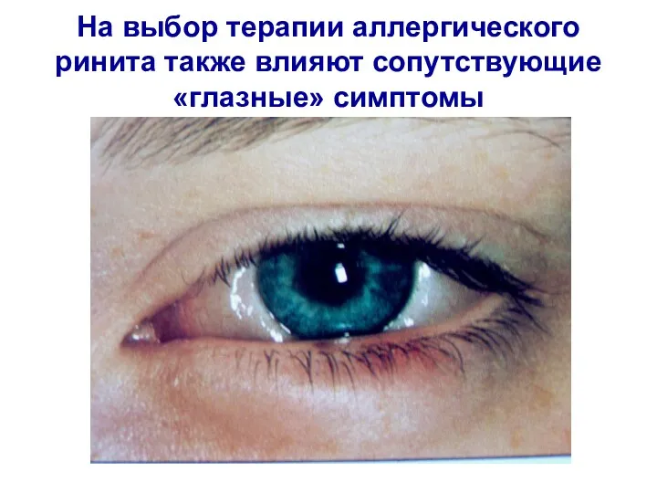 На выбор терапии аллергического ринита также влияют сопутствующие «глазные» симптомы