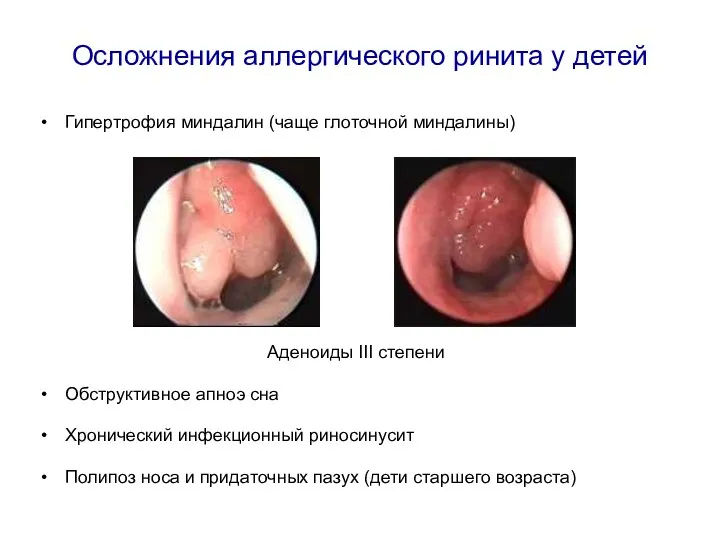 Осложнения аллергического ринита у детей Гипертрофия миндалин (чаще глоточной миндалины)