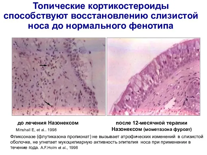 до лечения Назонексом после 12-месячной терапии Назонексом (мометазона фуроат) Minshall