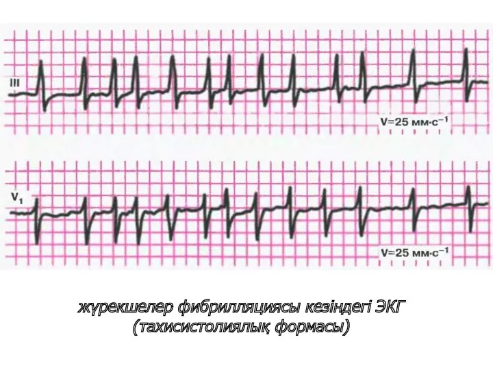 жүрекшелер фибрилляциясы кезіндегі ЭКГ (тахисистолиялық формасы)
